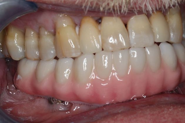 Teeth in a Day: Case 4 — Lower Implants after