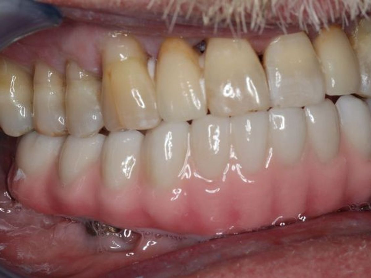 Teeth in a Day: Case 4 — Lower Implants after