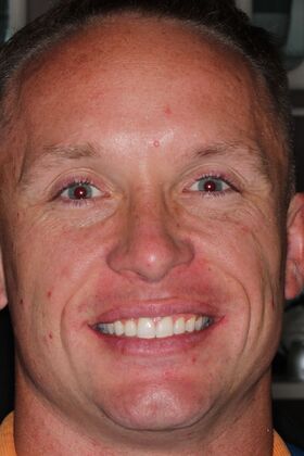 Invisalign: Case 1 - after
