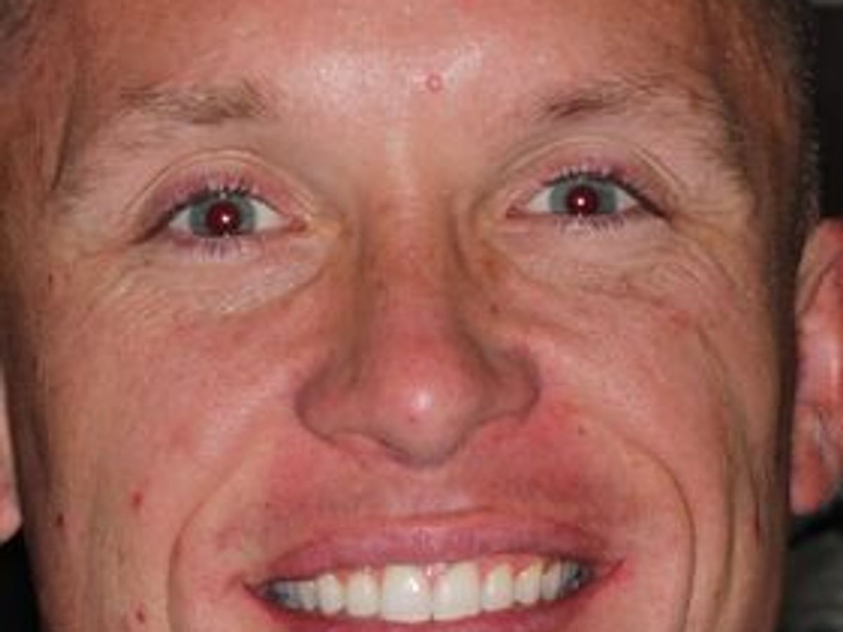 Invisalign: Case 1 — after