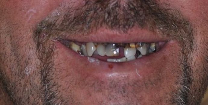 Dentures: Case 1 - before