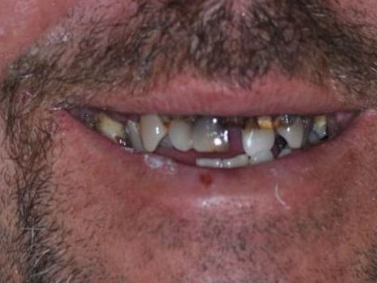 Dentures: Case 1 — before