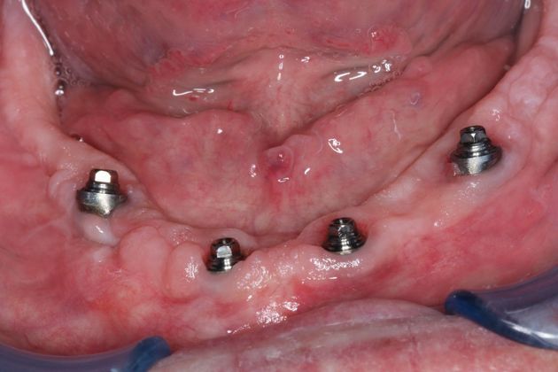 Teeth in a Day: Case 4 — Lower Implants before
