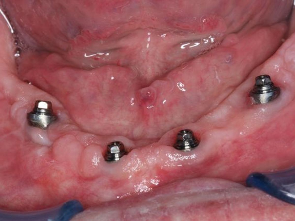 Teeth in a Day: Case 4 — Lower Implants before