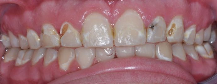 Dental Crowns: Case 2 — before