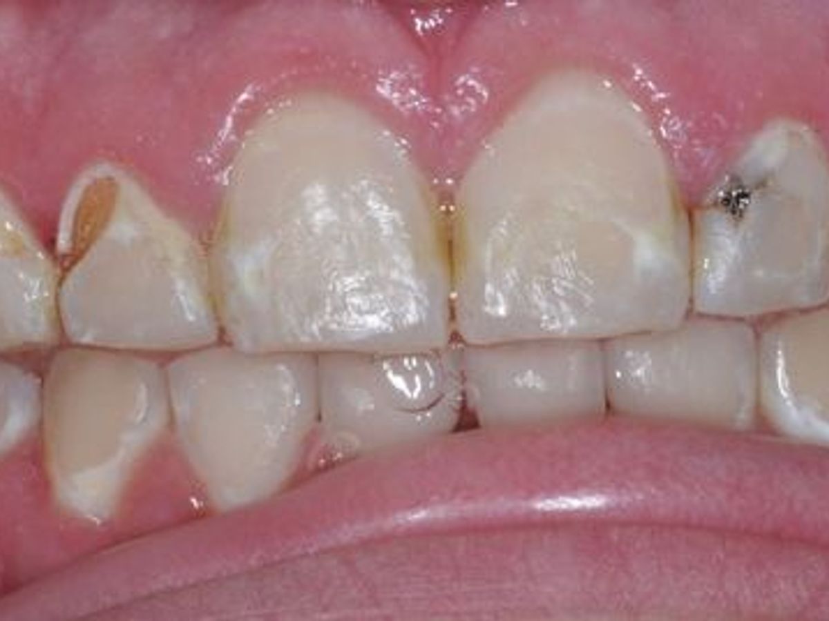 Dental Crowns: Case 2 — before