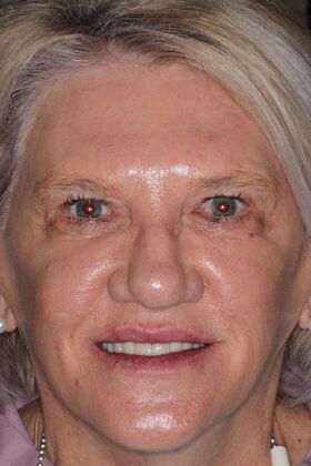 Dental Implants: Case 12 — after