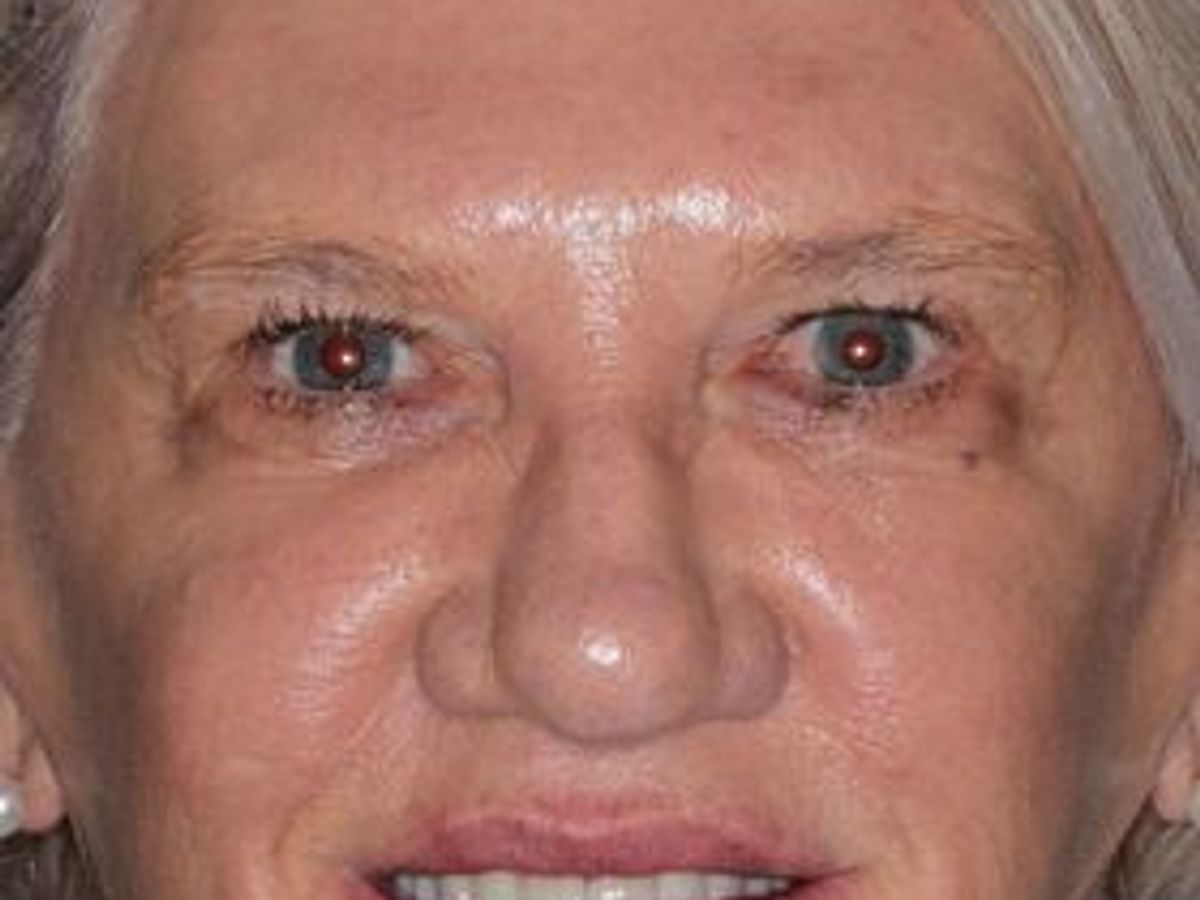 Dental Implants: Case 12 — after