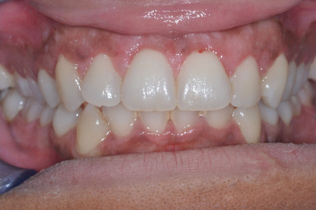 Gum Lift: Case 3 — 1 Month After Treatment after
