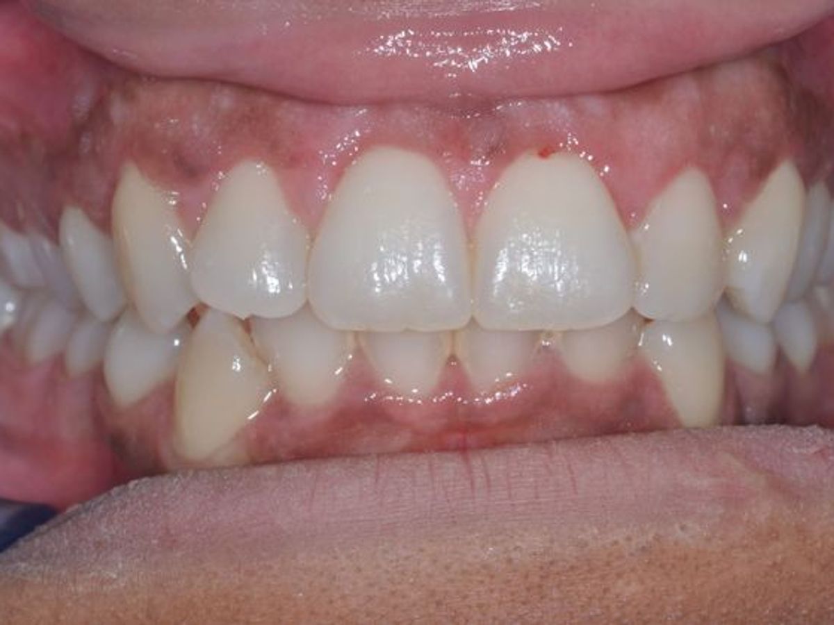 Gum Lift: Case 3 — 1 Month After Treatment after