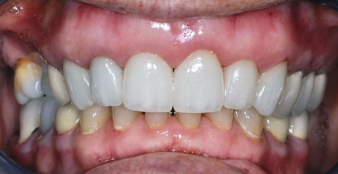 Dental Crowns: Case 22 — after