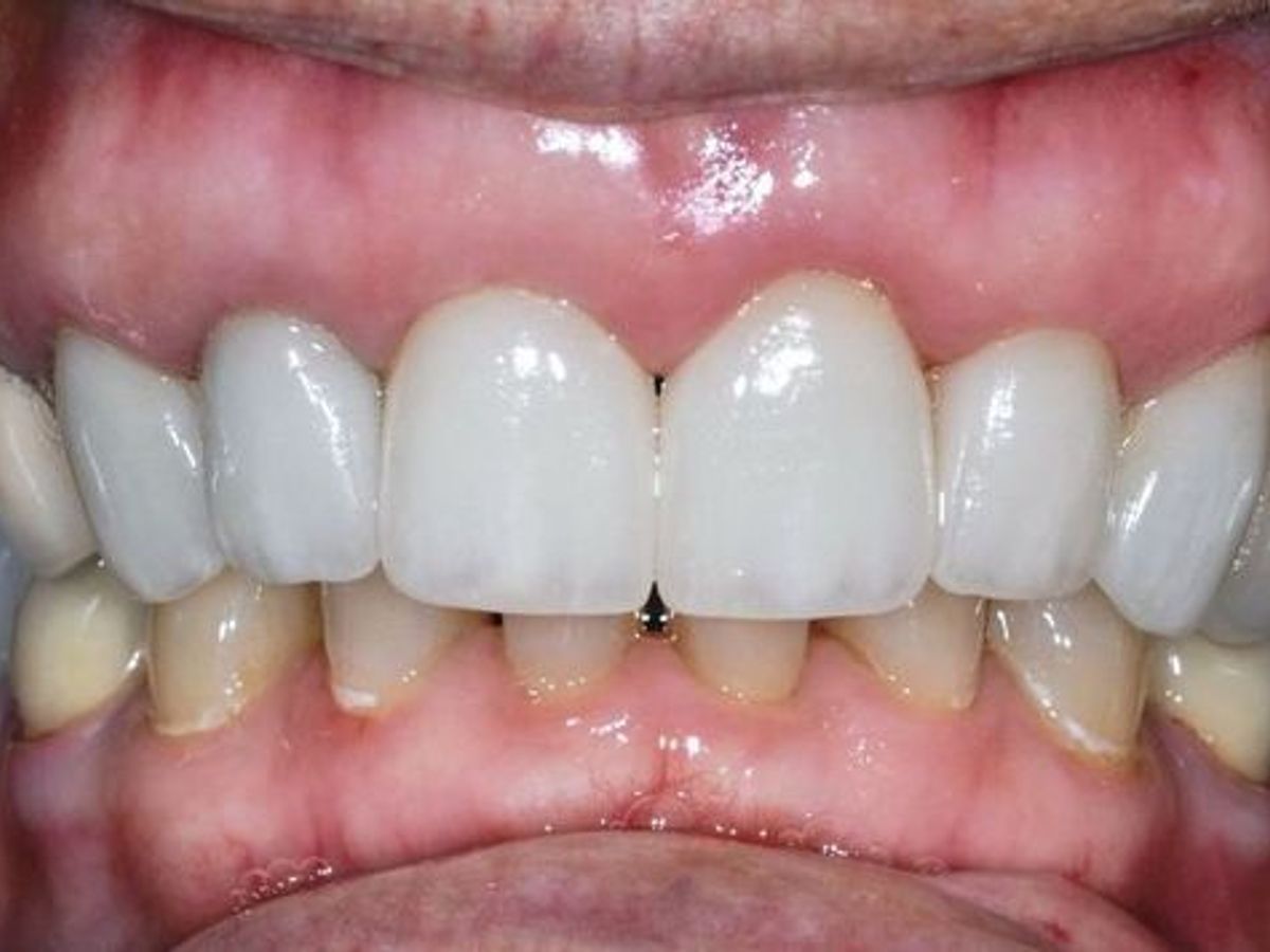Dental Crowns: Case 22 — after