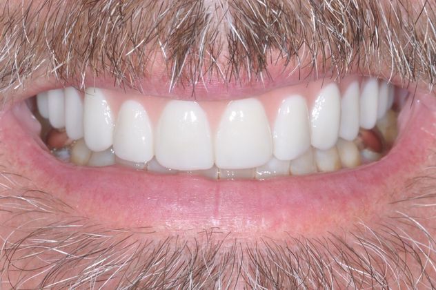 Teeth in a Day: Case 21 — Upper Prosthetic after