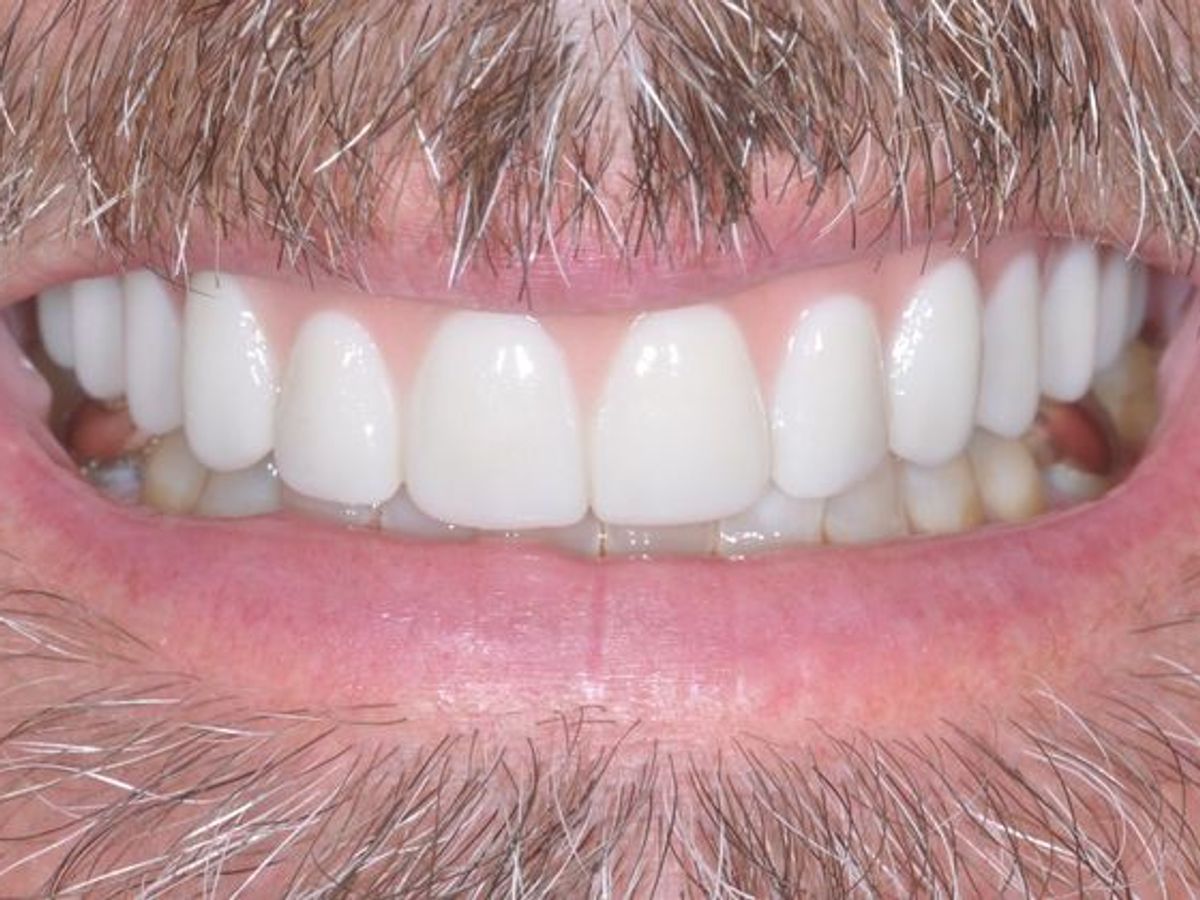 Teeth in a Day: Case 21 — Upper Prosthetic after