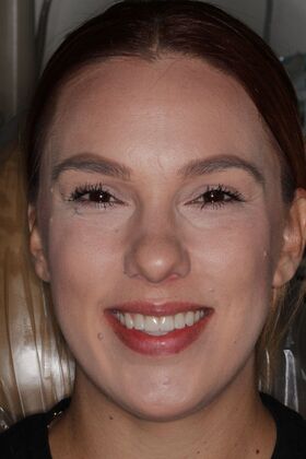 Veneers: Case 25 — after