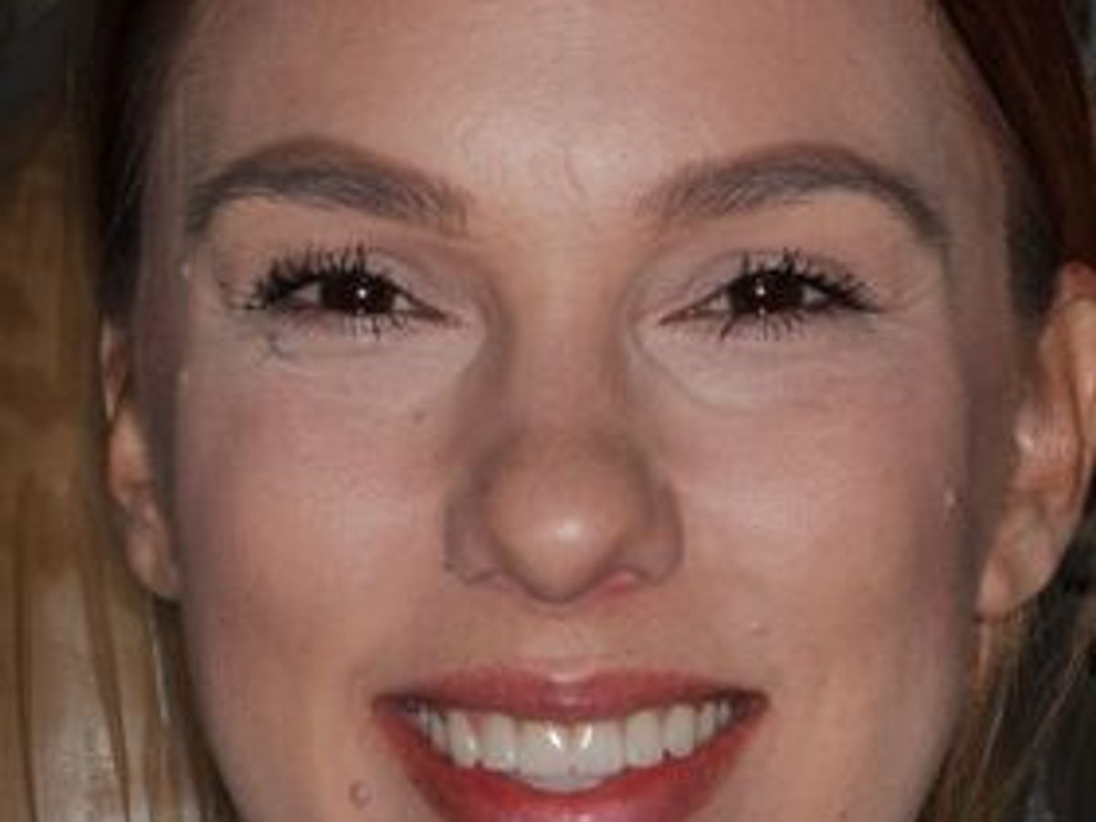 Veneers: Case 25 — after