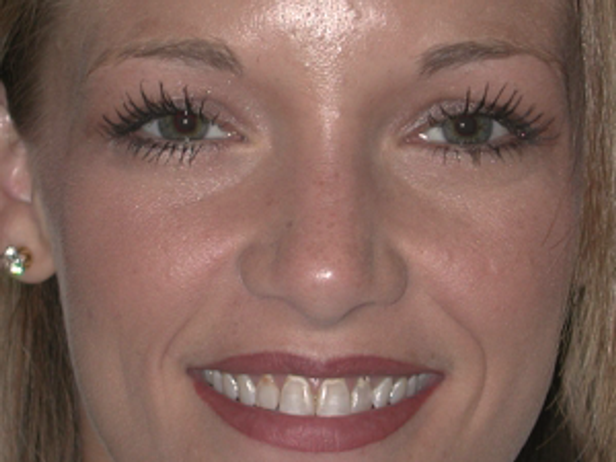 Veneers: Case 1 — before