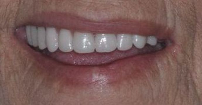 Teeth in a Day: Case 19 — after