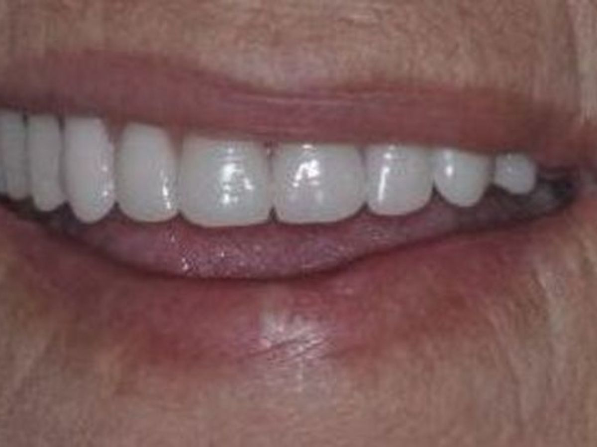 Teeth in a Day: Case 19 — after
