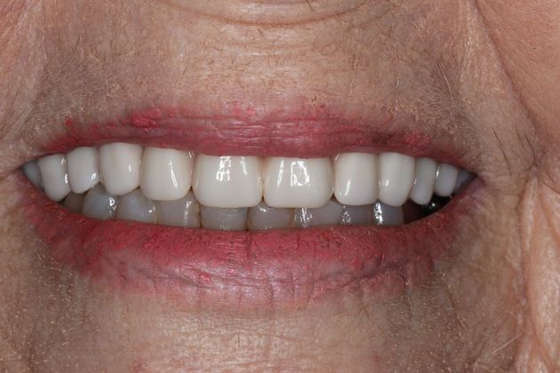 Teeth in a Day: Case 5 — Upper Arch after