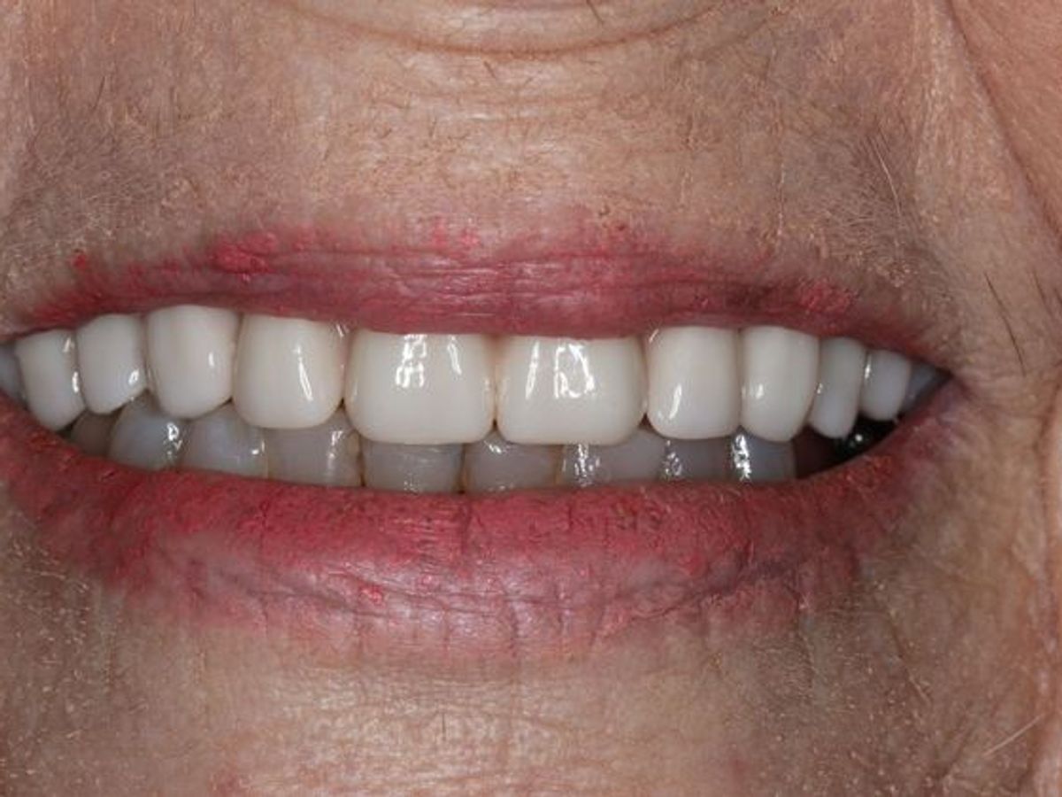 Teeth in a Day: Case 5 — Upper Arch after