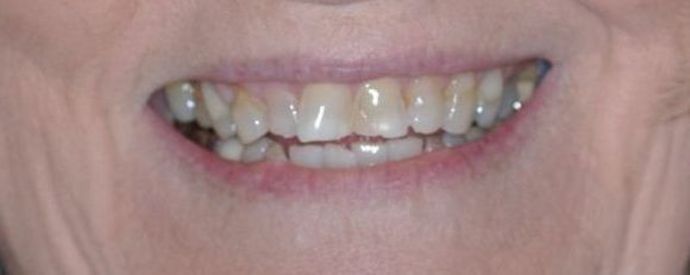 Dental Crowns: Case 13 — before