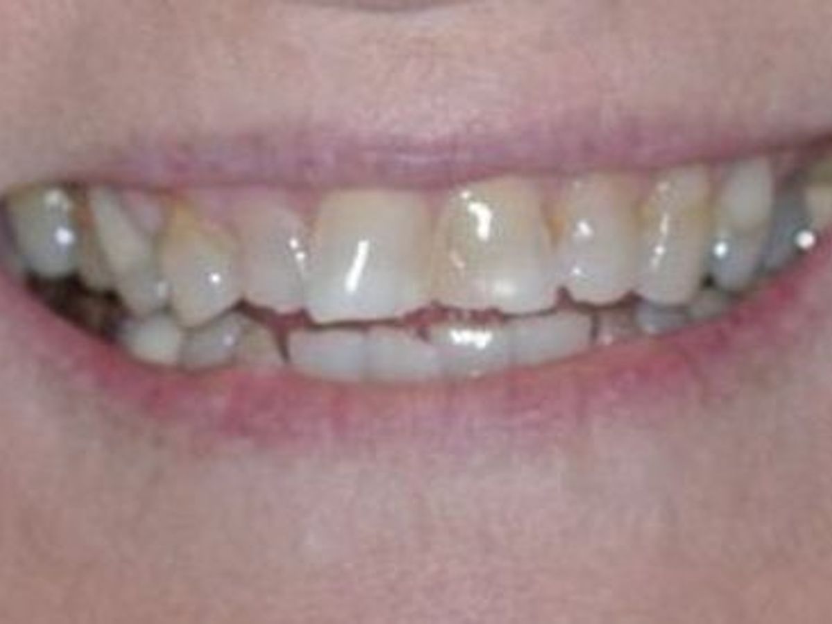 Dental Crowns: Case 13 — before