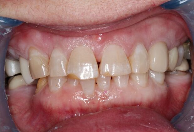 Dental Crowns: Case 35 — before
