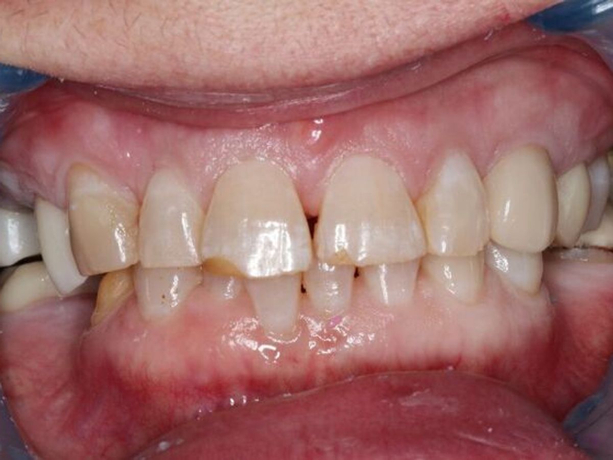 Dental Crowns: Case 35 — before