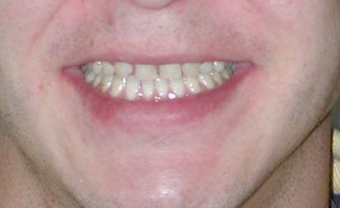 Veneers: Case 15 — before