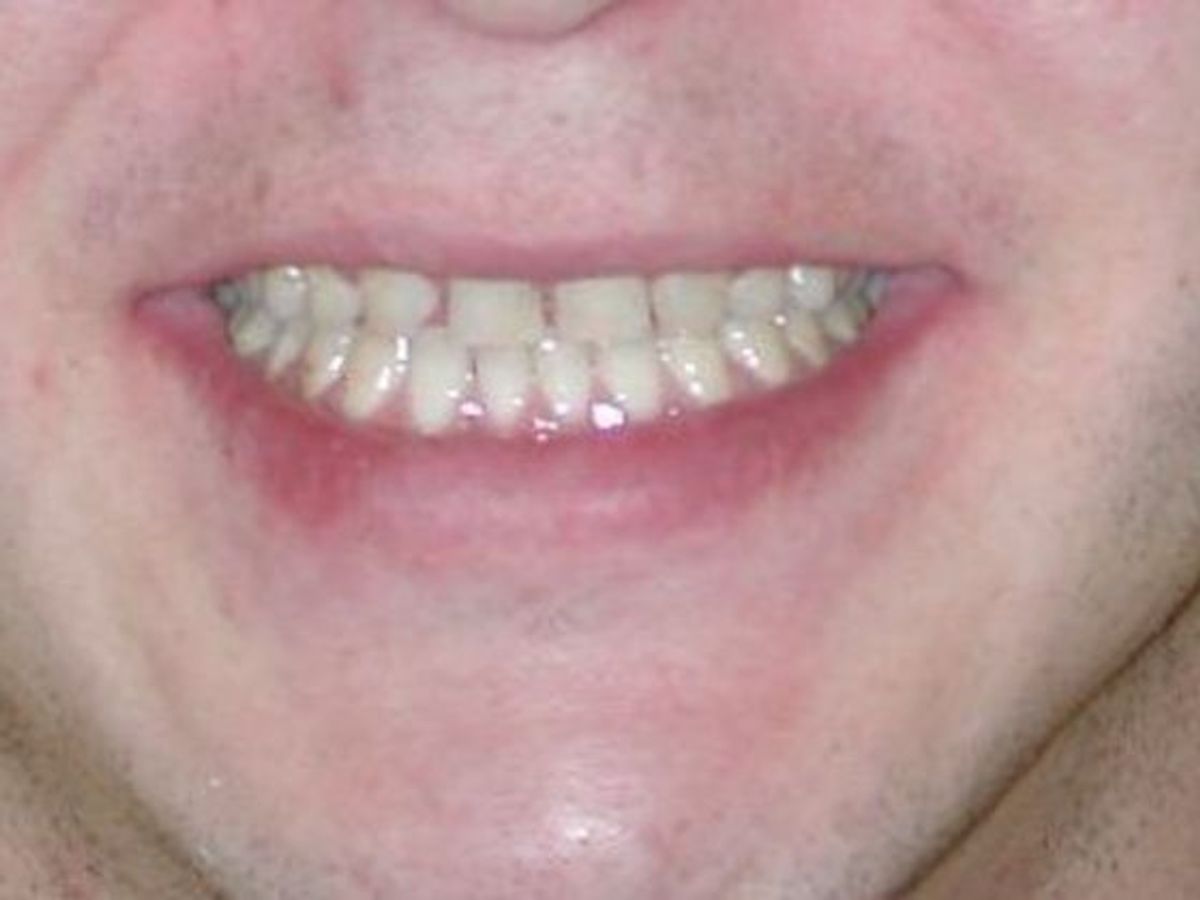 Veneers: Case 15 — before