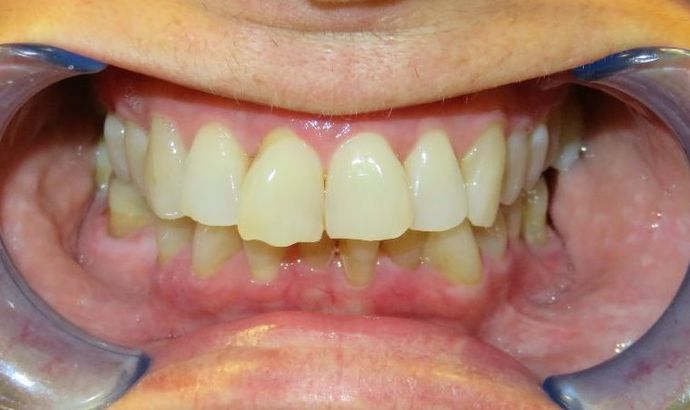 Dental Implants: Case 5 — before
