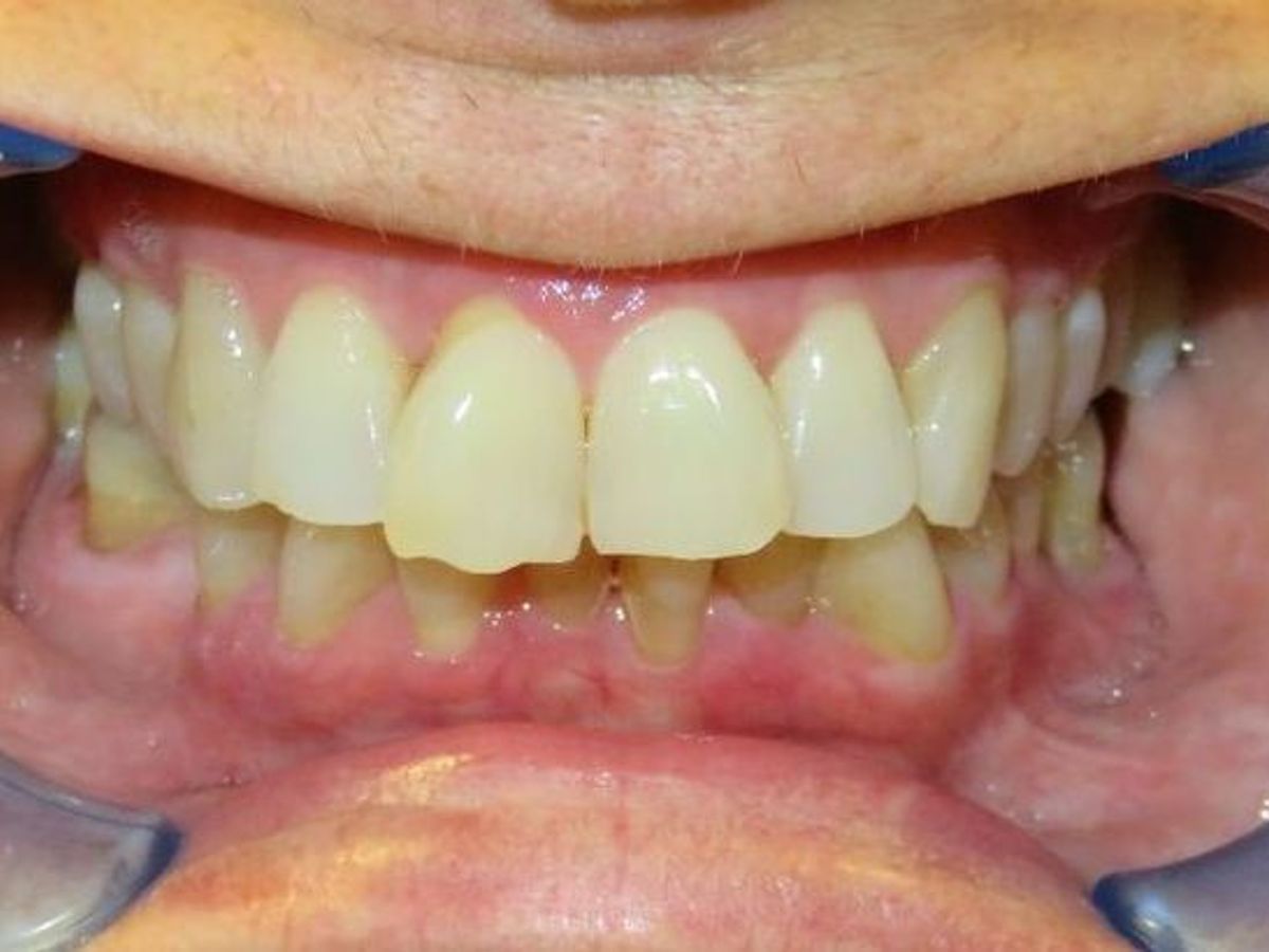 Dental Implants: Case 5 — before