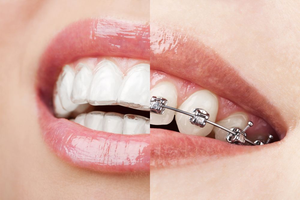 Invisalign vs. Braces: Which Treatment Is Right For Me?
