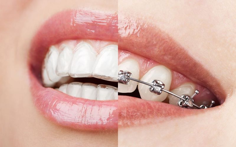 Invisalign vs. Braces: Which Treatment Is Right For Me?
