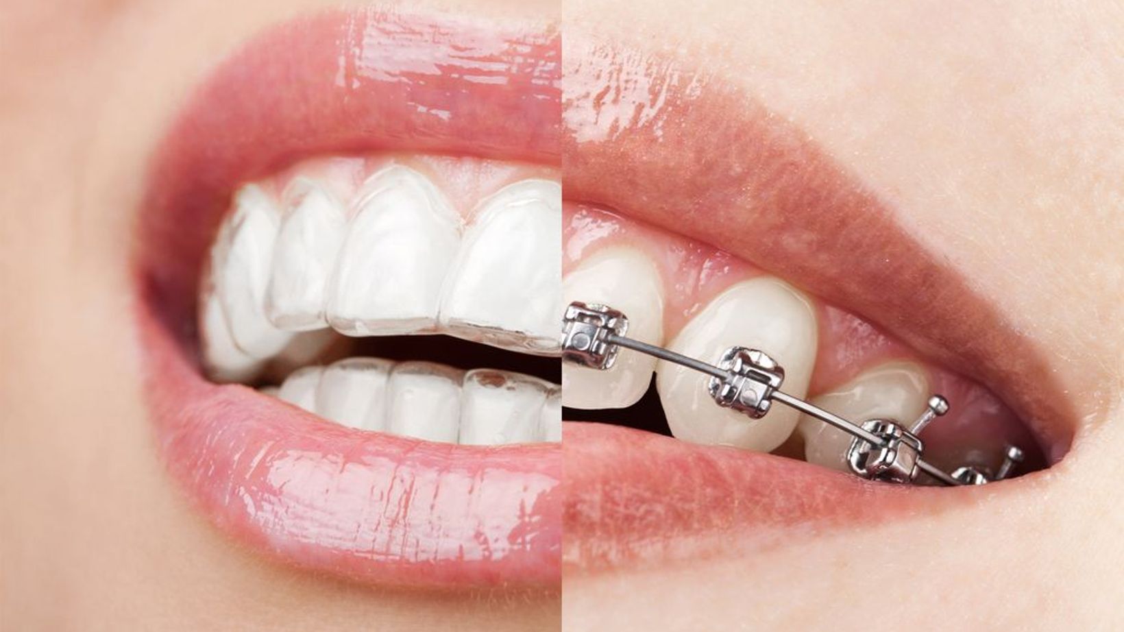 Invisalign vs. Braces: Which Treatment Is Right For Me?