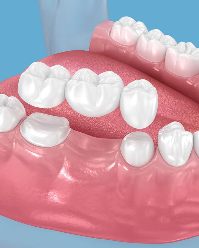 When there is too much gum tissue