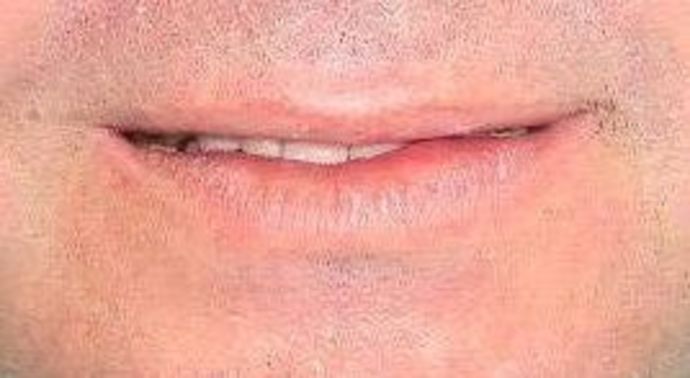 Full Mouth Reconstruction: Case 4 — before