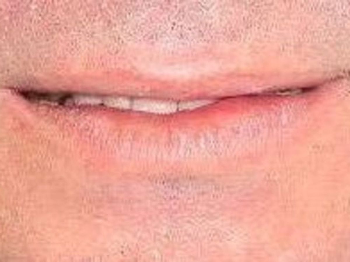 Full Mouth Reconstruction: Case 4 — before