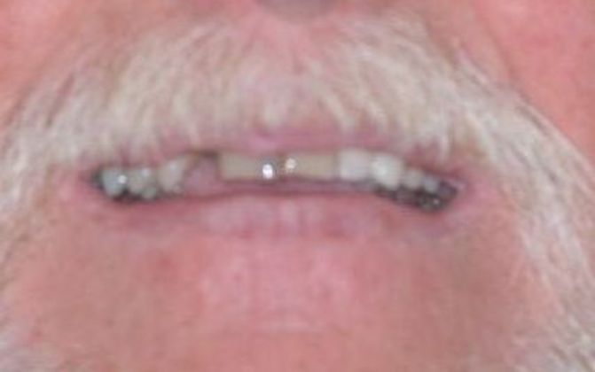 Dental Crowns: Case 27 — before