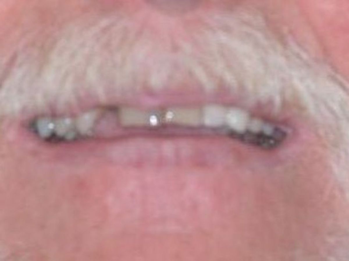 Dental Crowns: Case 27 — before