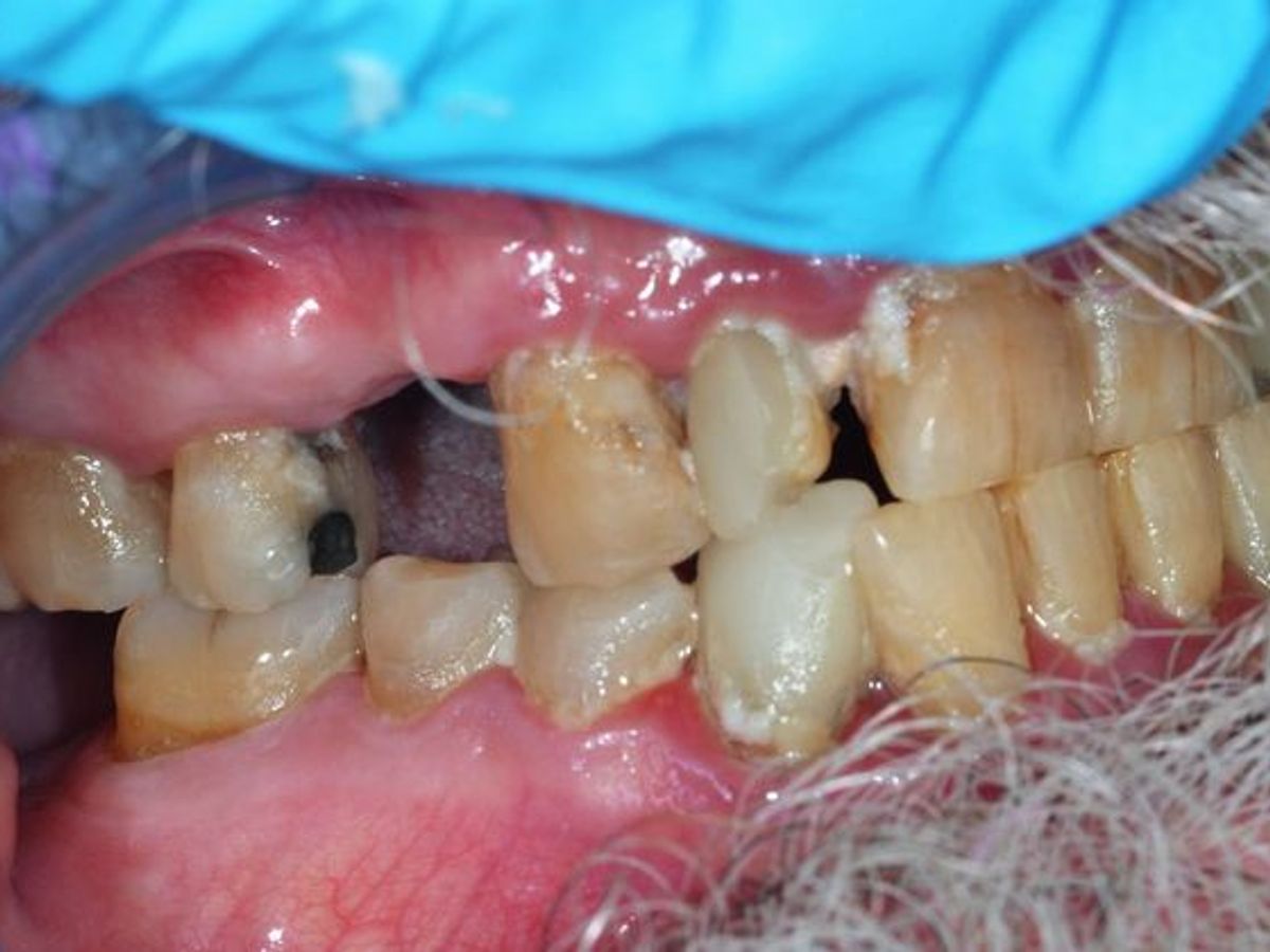 Teeth in a Day: Case 6 — before