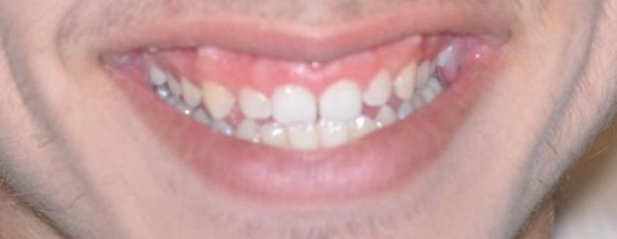 Gum Lift: Case 5 — after