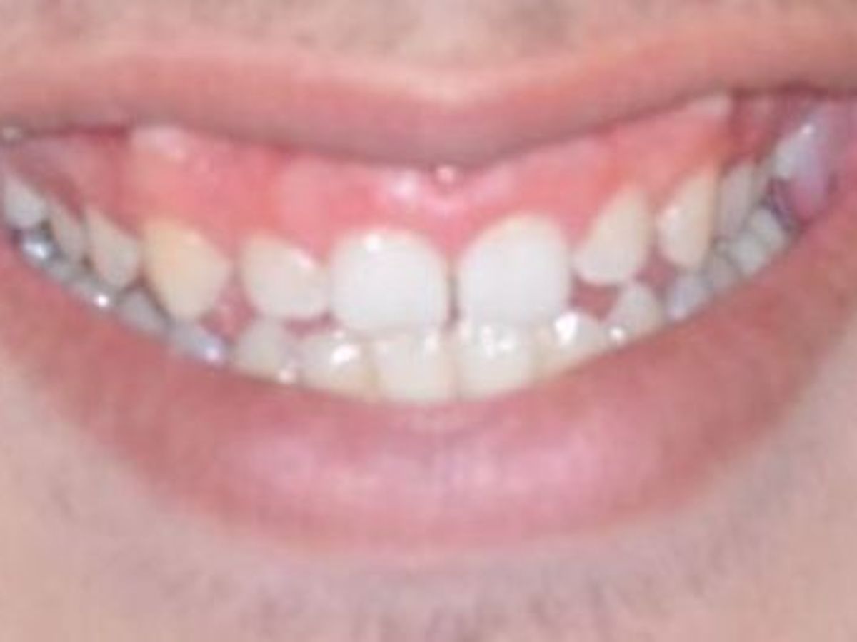Gum Lift: Case 5 — after