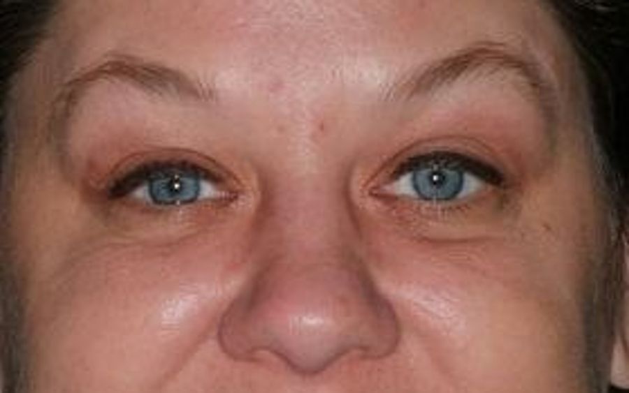 Bell Dental patient before implants