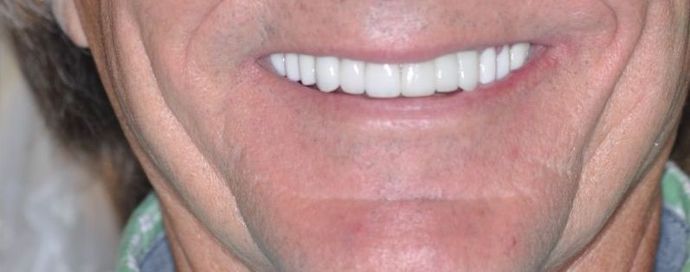 Dental Crowns: Case 12 — after