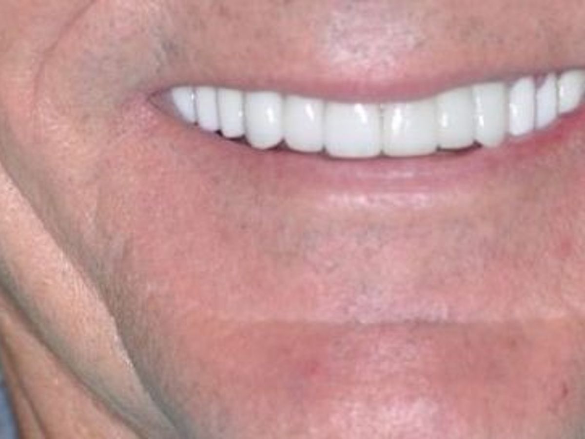 Dental Crowns: Case 12 — after