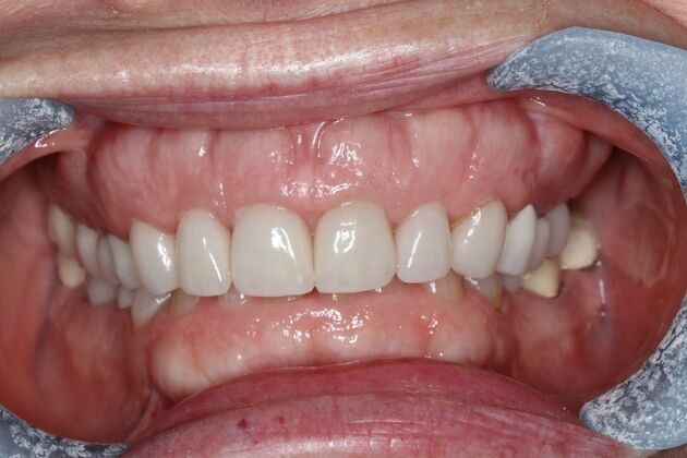 Veneers: Case 34 — before