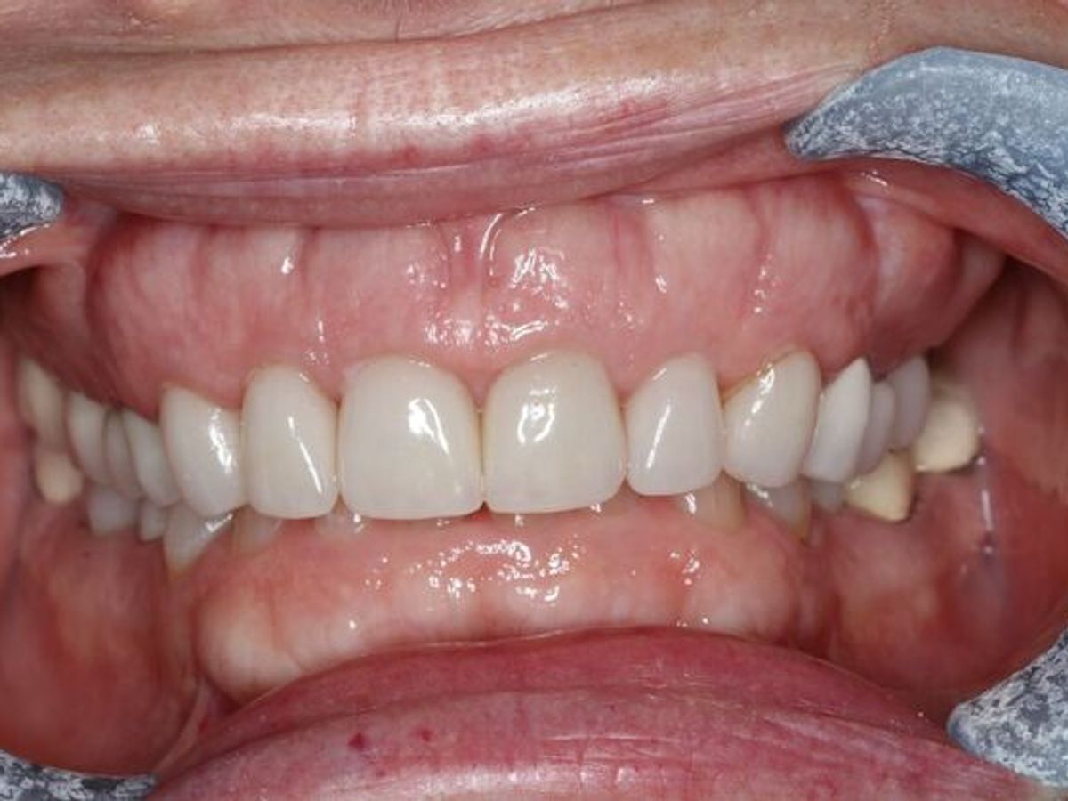 Veneers: Case 34 — before