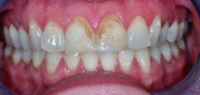 Dental Crowns: Case 20 — before